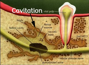 What are Cavitations?